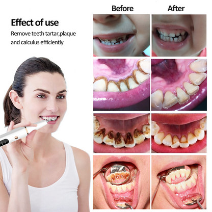 SmilePro2™ Ultrasonic Dental Scaler