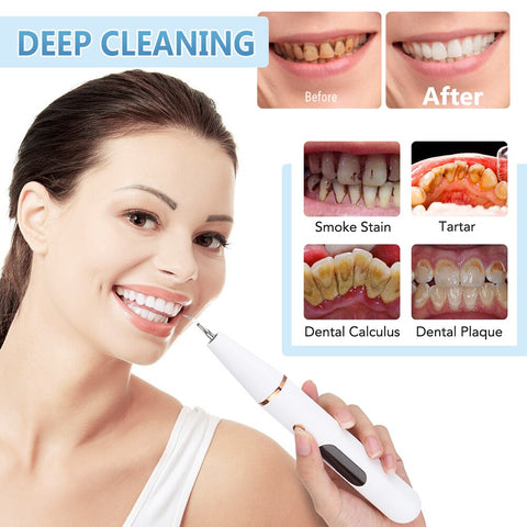 SmilePro™ Ultrasonic Dental Scaler